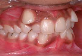 malocclusion